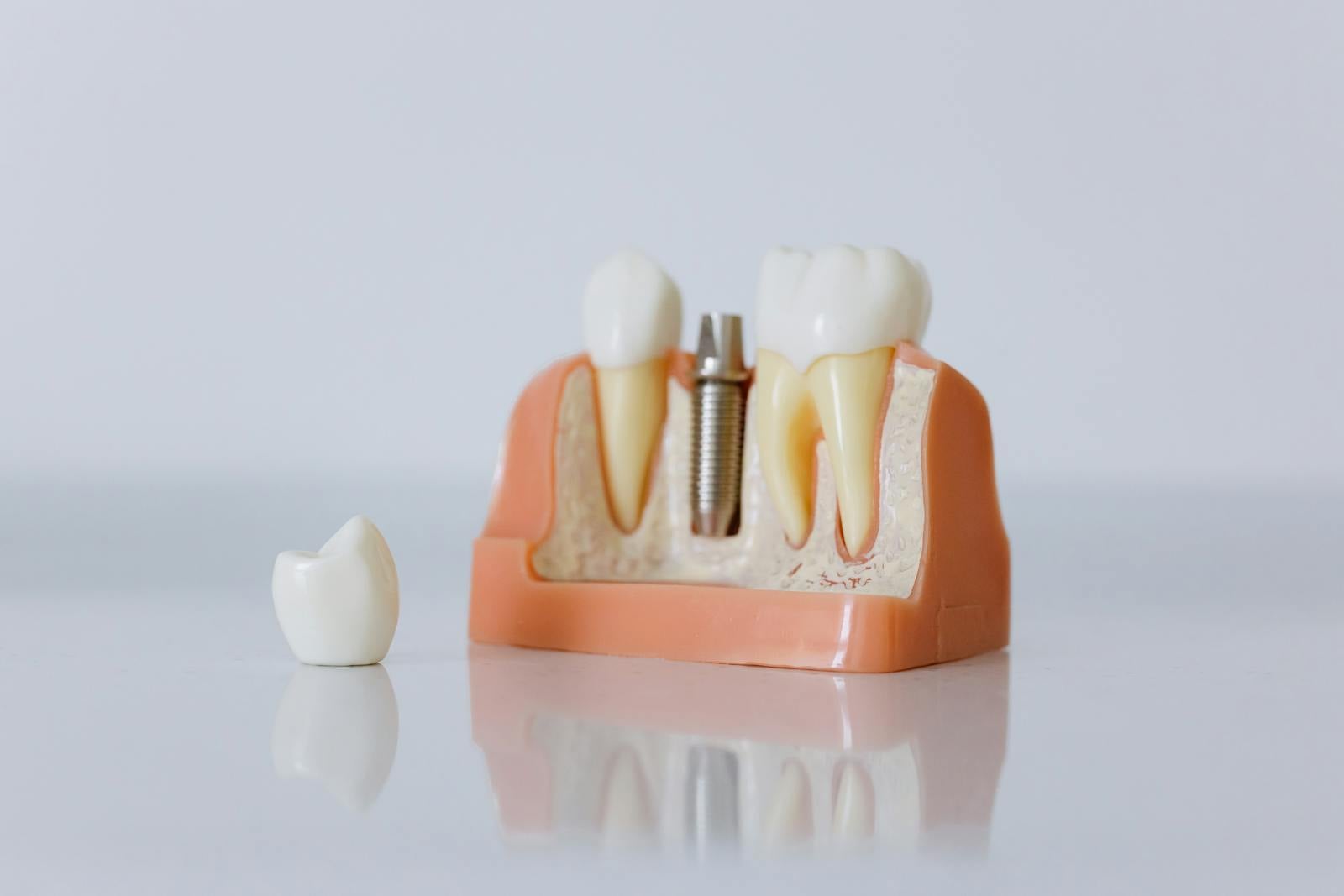 Implantes dentales en Sevilla - Piñero & Bilbao