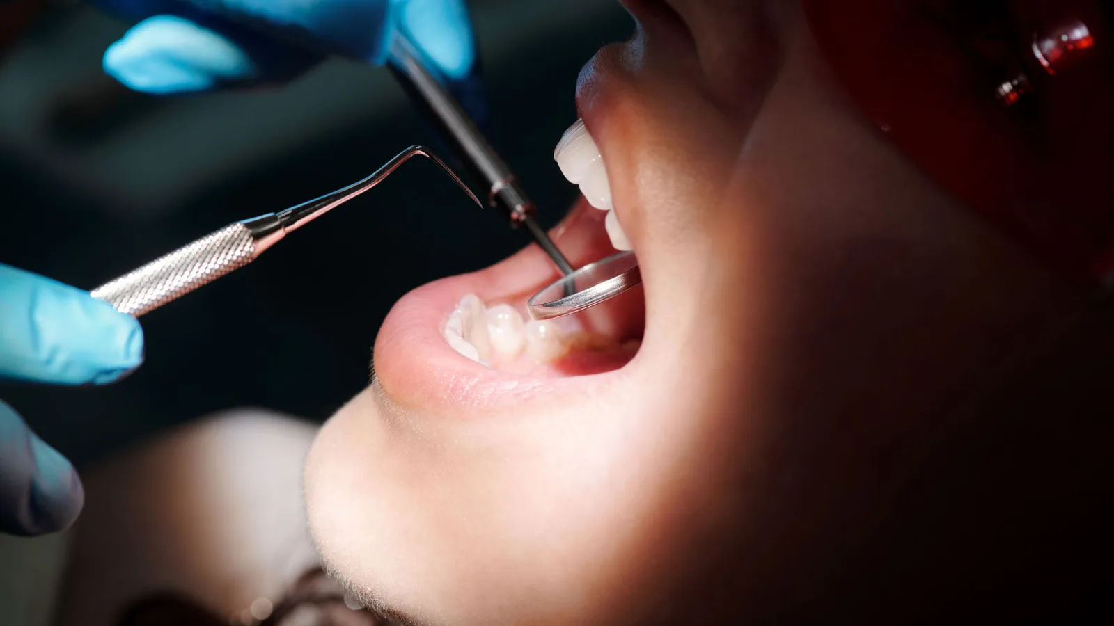 carillas de porcelana en Carillas dentales: cuándo sí, cuándo no y qué nadie te dice