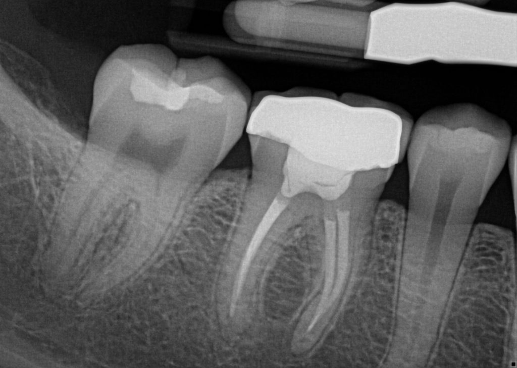 retratamiento endodoncia