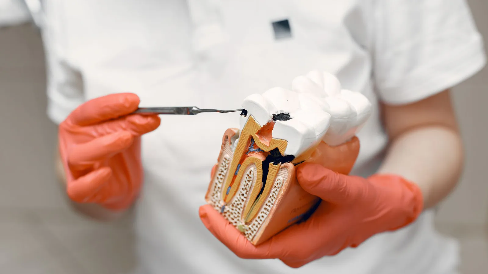 tratamiento de conductos en Endodoncia: cuándo se necesita, cómo es el procedimiento y si duele